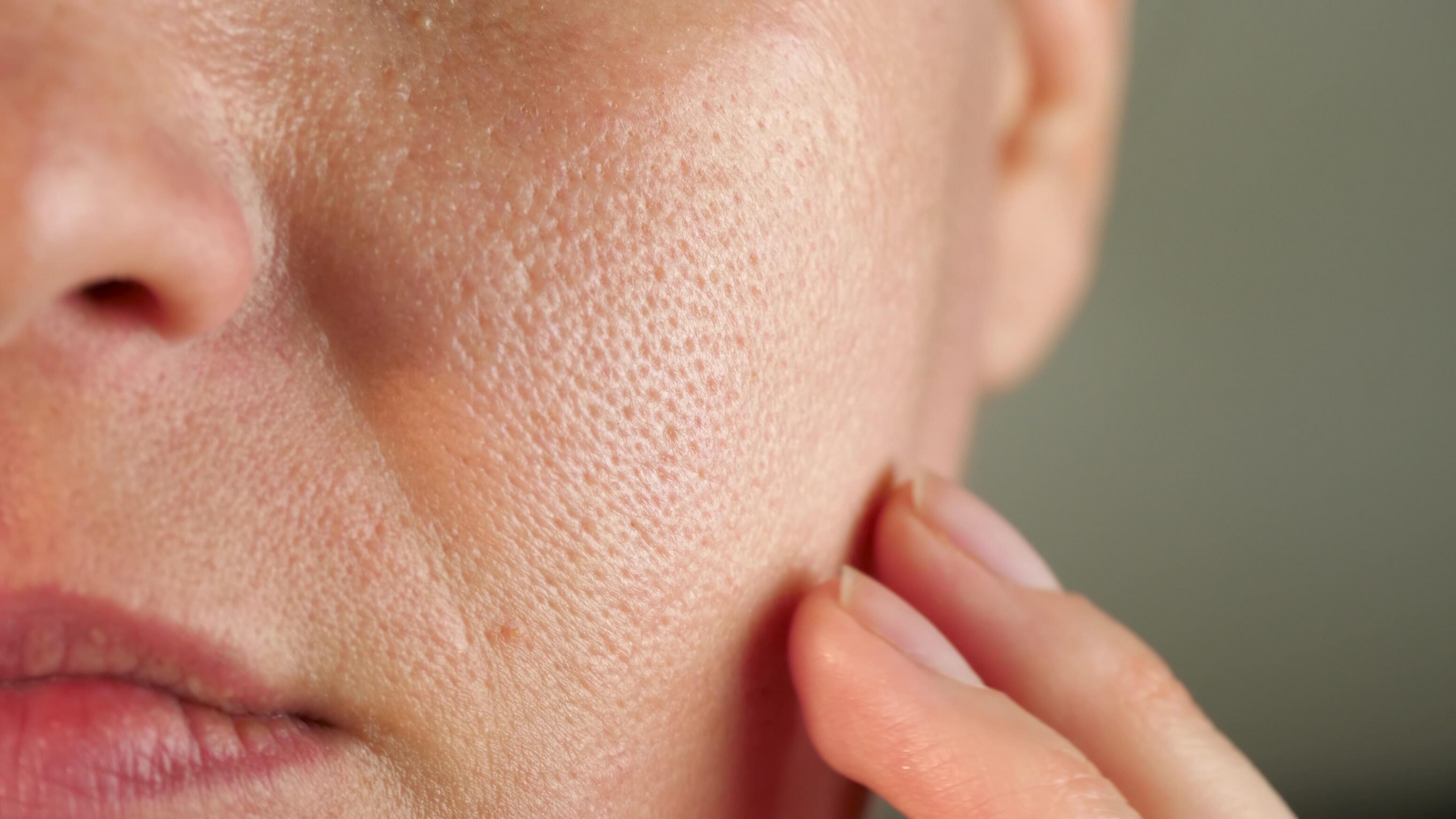 Retentional acne with enlarged pores